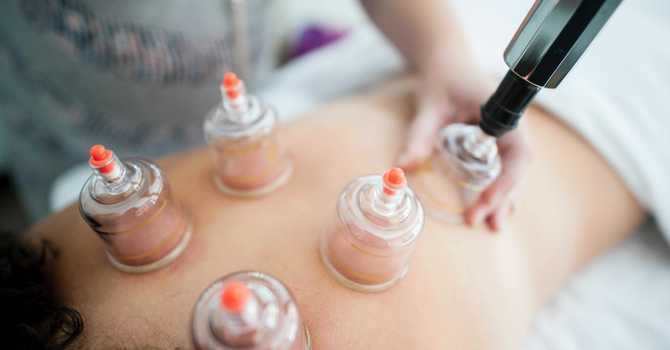Cupping Therapy